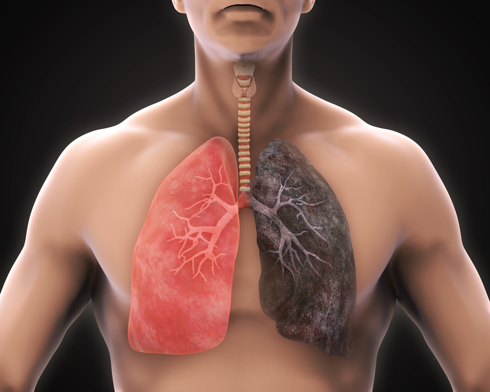 Top 4 cách phòng tránh bệnh ung thư phổi ai cũng nên biết